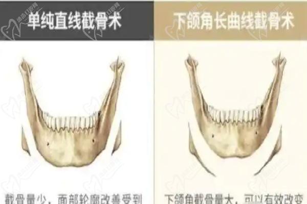 郭军磨骨病例:网红效应与真实反馈 郭军磨骨病例:网红效应与真实反馈
