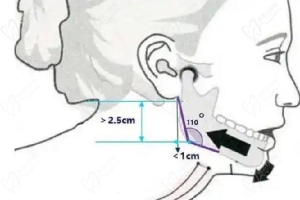 郭军磨骨怎么样 郭军磨骨怎么样