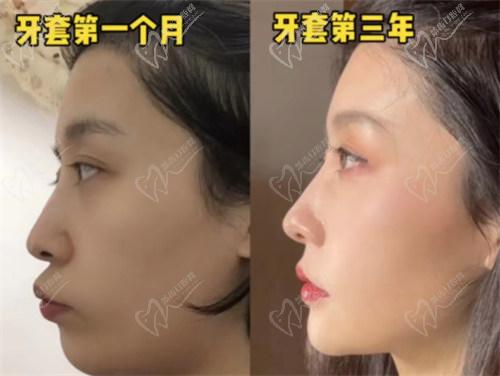 影响牙齿矫正价格的因素：