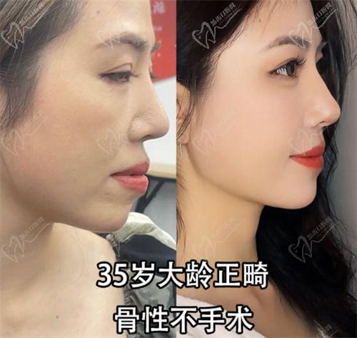 国内牙齿矫正的流程：