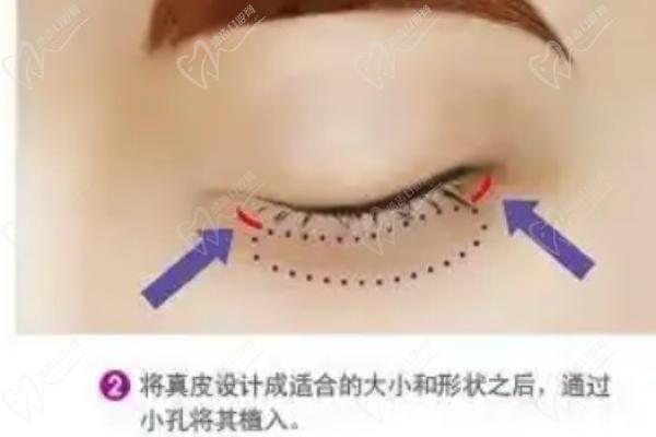 上海九慕医疗美容医院祛眼袋医生推荐