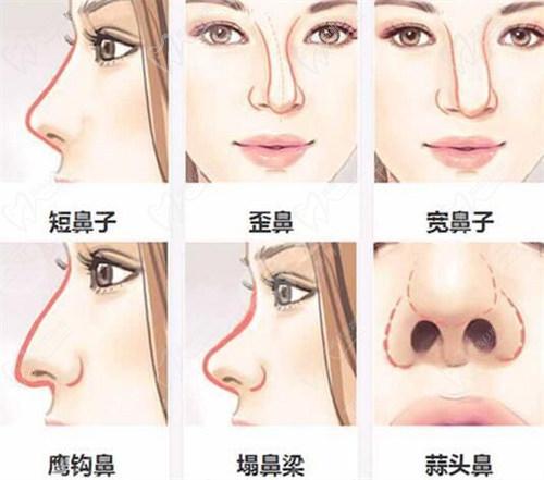 洪春医生做鼻子做得怎么样？