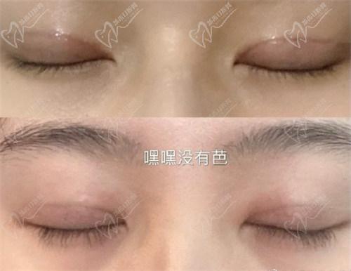 北京丰联丽格医疗美容师丽丽修复双眼皮怎么样？