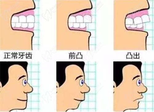 正颌手术的过程