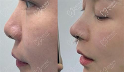 李旭平医生简介： 李旭平医生是一位在西安国内外医学中 心医院从事整形美容的从业多年医生，拥有十余年的临床经验。他是国内医学美容研究协会的委员，以其专精的医疗技术和良好的患者沟通能力而驰名。 李旭平医生是一位具有影响力的整形外科骨干医生，长期以来专注于美容整形手术，尤其是在双眼皮、隆鼻、瘢痕整复等项目上积累了丰富的经验。他的专精技能得到了众多患者的认可和赞誉。 李旭平医生的专精领域： 李旭平医生擅长的领域包括： - 双眼皮手术：根据求美者的眼部特点，设计个性化的双眼皮形态，使眼睛更加美丽自然。 - 隆鼻手术：结合面部整体协调性，提升鼻部的立体感。 - 瘢痕整复：对各种类型的瘢痕进行细致的治疗与修复。 - 注射美容：如<span style=