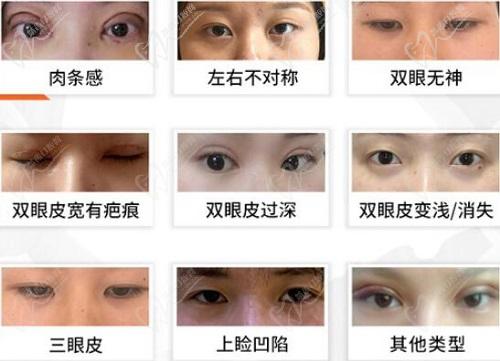 谭琳双眼皮修复技术特色