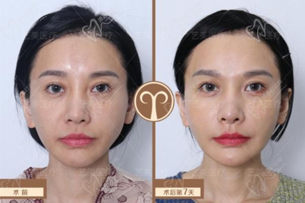北京艺美王东修复脂肪好不好