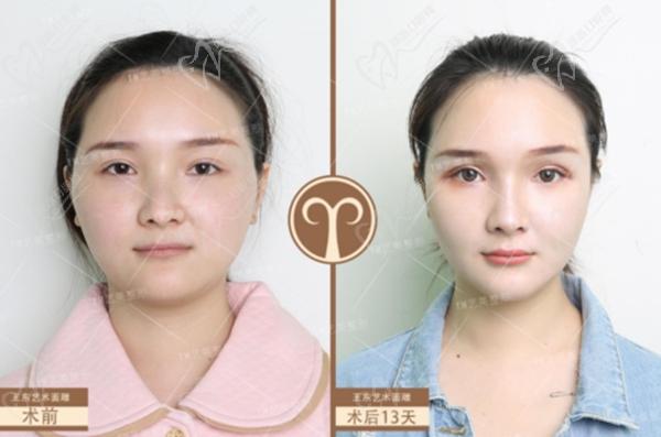 北京艺美王东修复脂肪好不好