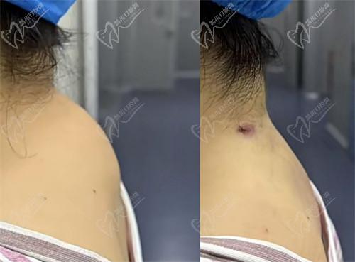 三、【隆鼻价格】北京紫洁医疗美容隆鼻分类及费用标准