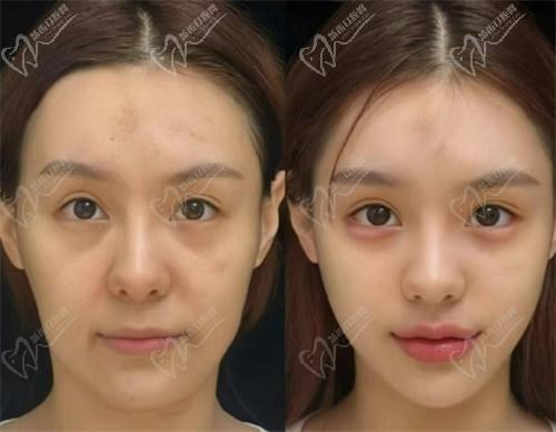 五、【双眼皮价格】北京紫洁医疗美容双眼皮手术费用全解析