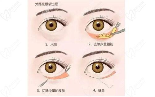 四、北京紫洁医院谁做眼袋好？