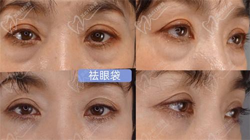 二、北京紫洁医疗去眼袋怎么样,不开刀去眼袋可靠吗?