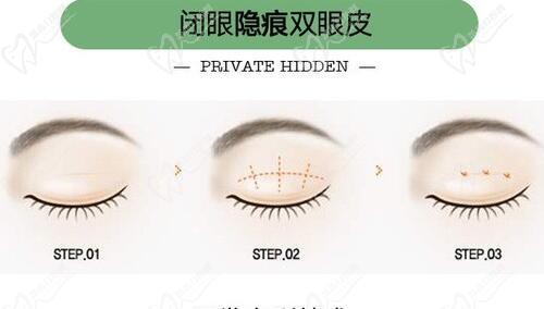 雷义波医生双眼皮手术过程
