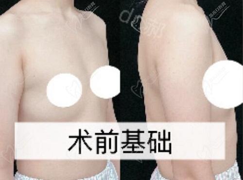 我找郝永生隆胸术前基础