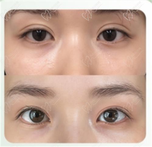 魏志香双眼皮修复的怎么样