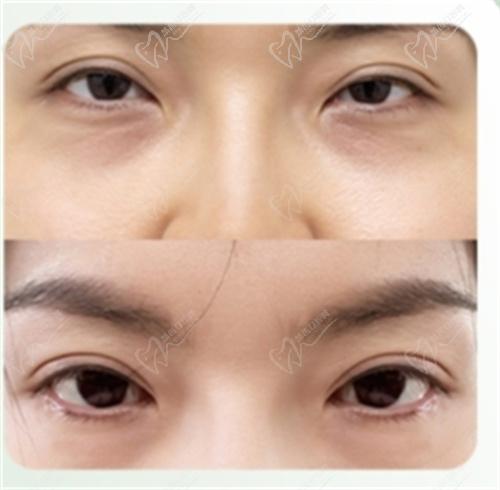魏志香双眼皮修复实例