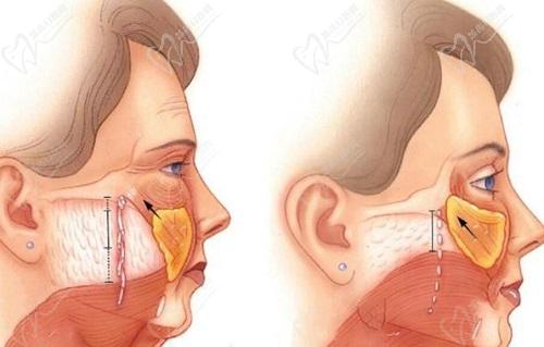 杨俊医生的拉皮技术能力得到了广泛认可