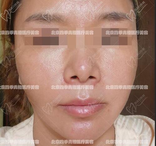 北京四季青橙杨俊拉皮术后照片