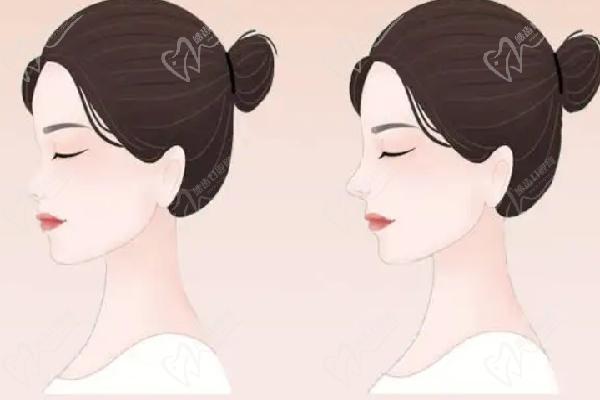 杨水斌医生鼻整形手术费用