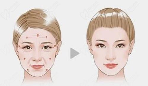 杨俊和黄寅守拉皮手术和审美那个更好？ 