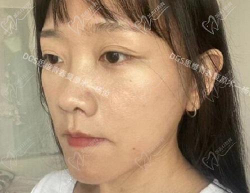 北京杨俊和黄寅守拉皮手术真人实例对比