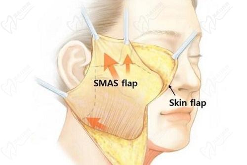 黄寅守和杨俊拉皮谁更厉 害？