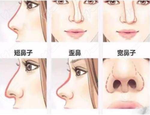 武汉吴辉医生做鼻子怎么样