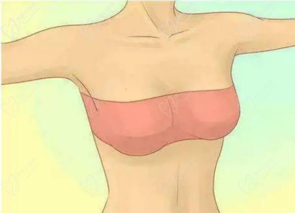 广州李俊明医生隆胸怎么样 广州李俊明医生隆胸怎么样