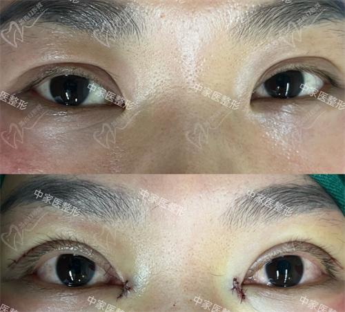 田芳斌医生眼修复真人实例