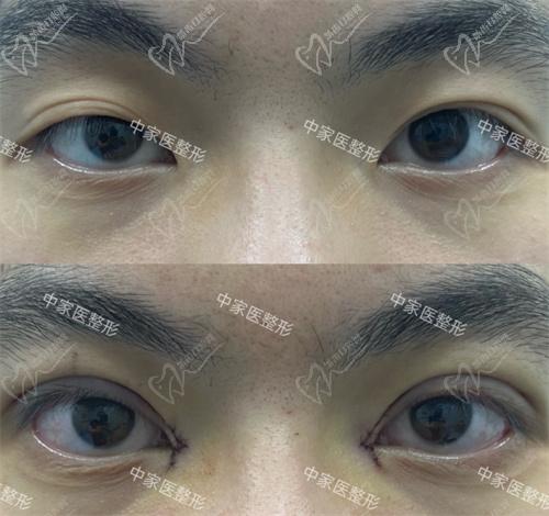 田芳斌医生眼修复真人实例