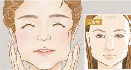 广州广大罗延平医生磨骨比较好