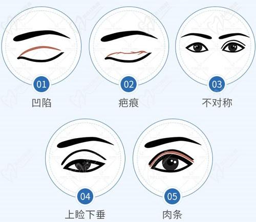 杭州杨连华修复双眼皮多少钱？