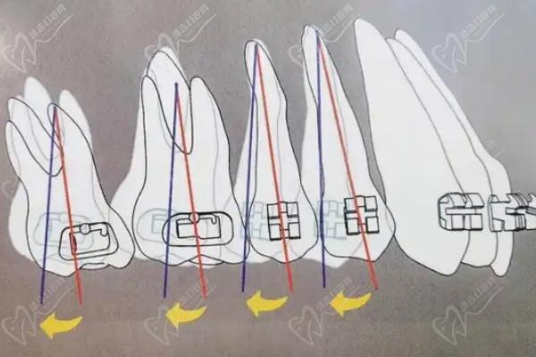 北京禾禾齿科贺娜医生做隐形矫正术中