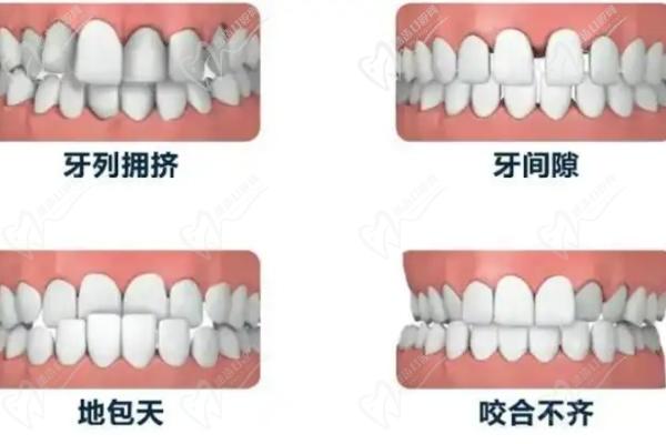 北京禾禾齿科贺娜医生做隐形矫正术后 1 年