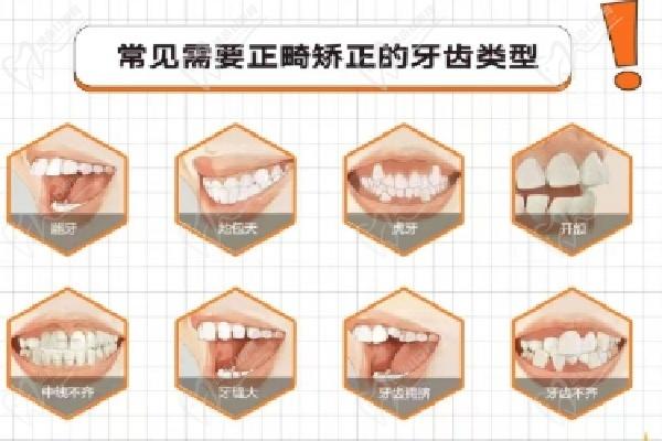 北京禾禾齿科贺娜医生做隐形矫正术后 2 年