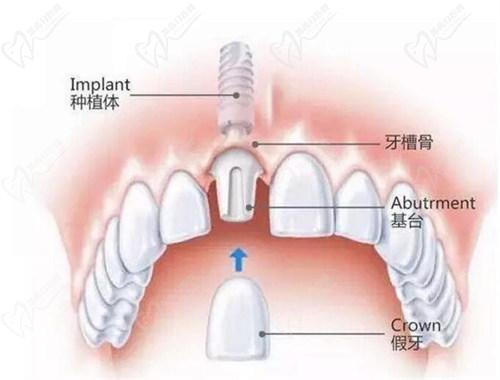 【三、诺贝尔口腔医生团队与专精保护】