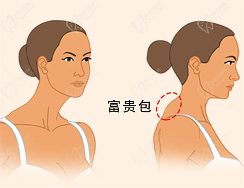 广州李方伟医生费用一般几万