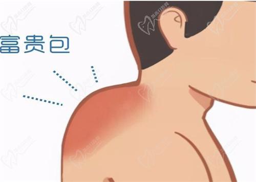 广州李方伟医生做富贵包怎样