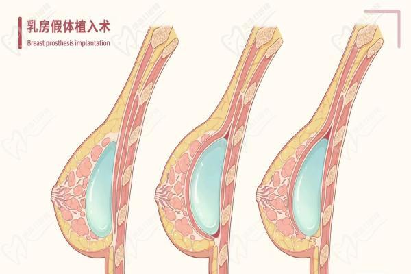 深圳八大处隆胸好的医生李罡技术不错,八大处定制美胸反馈好附价格