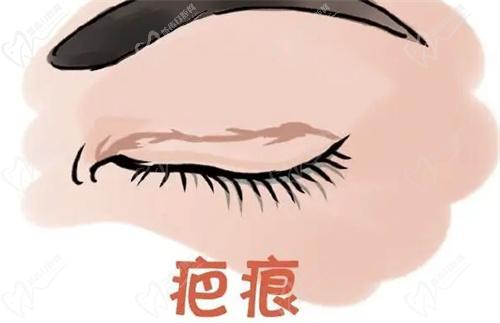 车红昌双眼皮修复怎么样