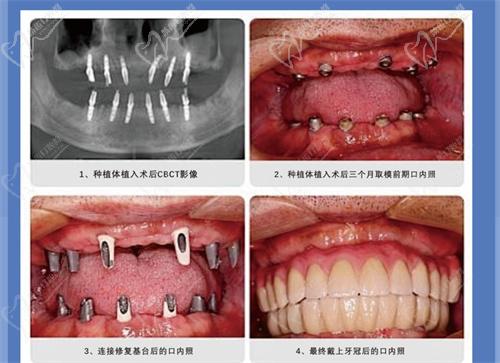 李聪颖医生医生种植牙实例