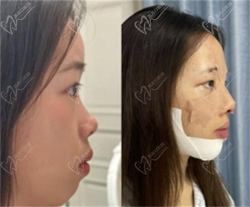 杨水斌医生做鼻子实例
