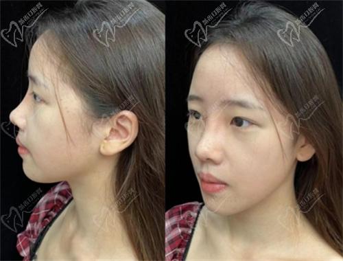 杨水斌医生做鼻子实例
