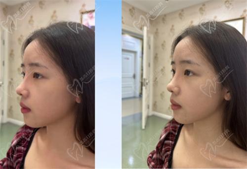 杨水斌医生做鼻子前后对比