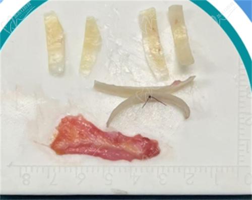 杨水斌医生隆鼻实例