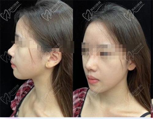 杨水斌医生做鼻子好吗