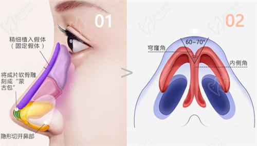杨水斌医生做鼻子实例
