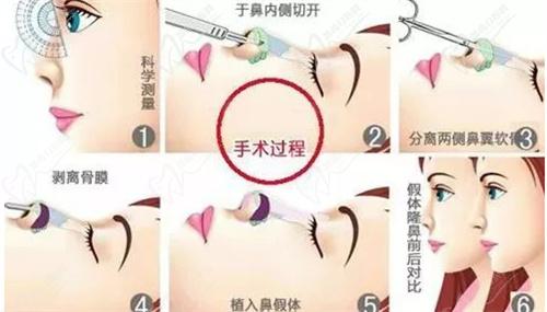 杨水斌医生做鼻子口碑