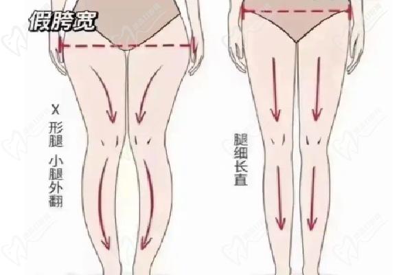 郑京桓医生做吸脂