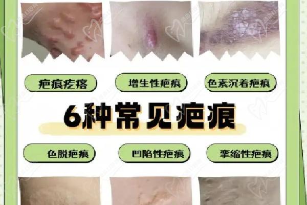 北京烧伤疤痕修复医院推荐